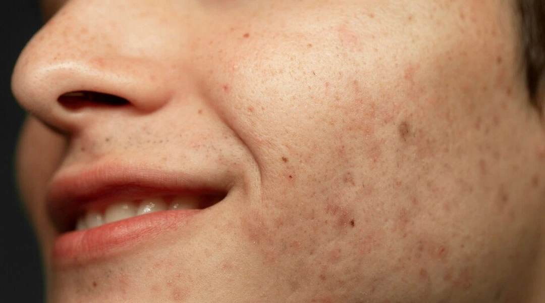 Simple Home Remedies To Remove Acne Scars